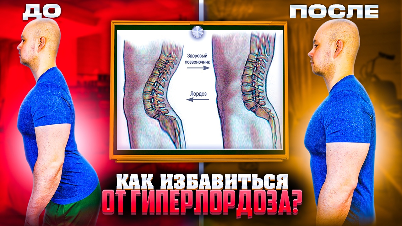 КАК ИЗБАВИТЬСЯ ОТ ГИПЕРЛОРДОЗА!? смотреть онлайн