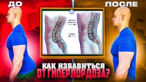 КАК ИЗБАВИТЬСЯ ОТ ГИПЕРЛОРДОЗА!?