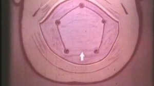 Костнопластическая трепанация © The technique of bone trepanation