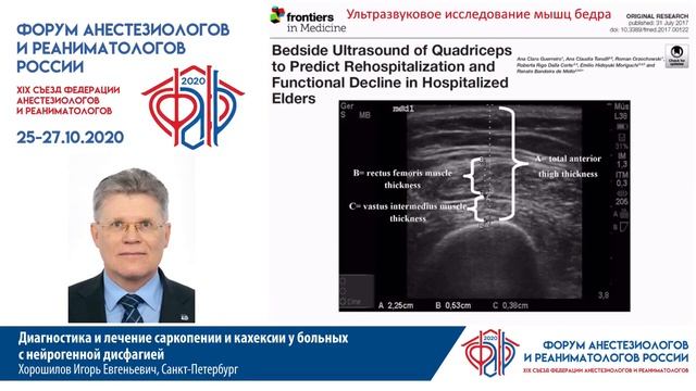 Оценка кахексии при нейрогенной дисфагии Хоршилов И.Е. смотреть онлайн