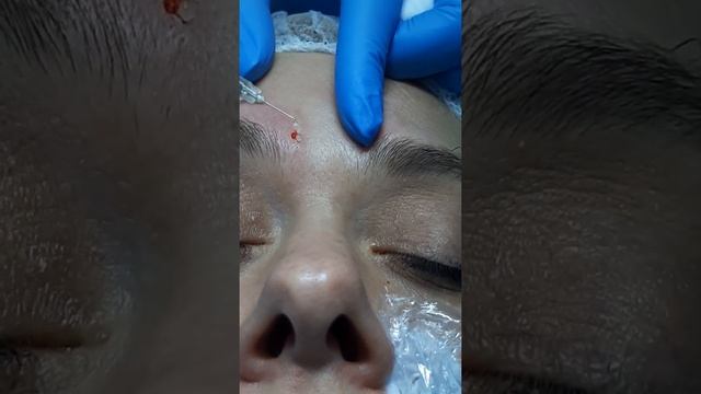 Бланшинг межбровья смотреть онлайн