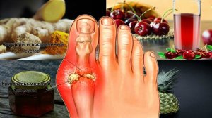 Что делать при подагре?!?***Народная медицина поможет***Подагре нет!!!