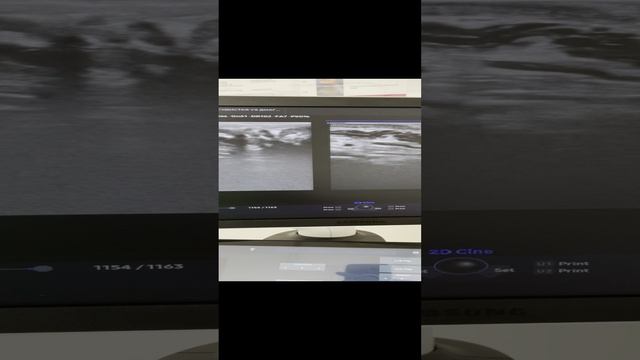 Двустороннее варикоцеле. Варикоз малого таза. Уролог. Сосудистый хирург Москва. Флеболог Москва смотреть онлайн