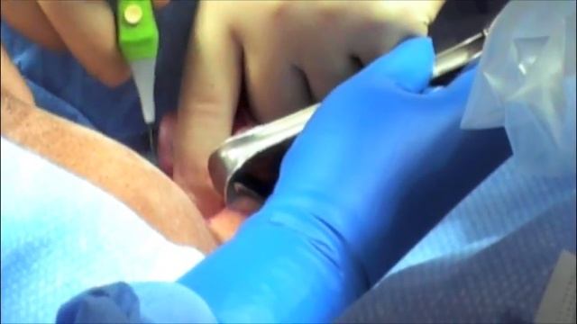 Graphic PlasmaBlade Node Dissection Surgery using the PEAK Surgical PlasmaBladeTM (no audio) смотреть онлайн