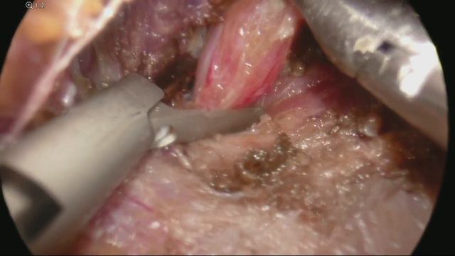 Transoral Endoscopic Thyroidectomy, Dr. Jeremy Richmon, Mass Eye and Ear смотреть онлайн