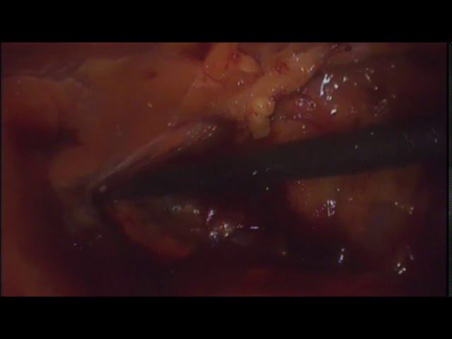 Laparoscopic ETEP Inguinal Hernia