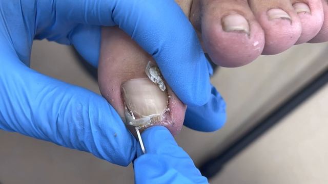 Pedicure Tutorial：Dirty Toenail Trim!【Pedicure Master Lin Jun】