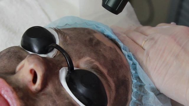 Урок. Лазерный карбоновый пилинг.mp4 смотреть онлайн