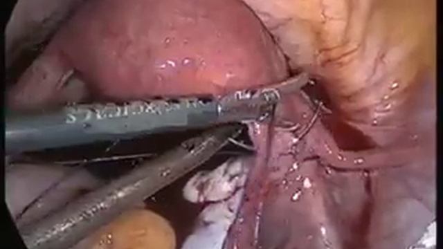 Laparoscopic overian suspension in twisted overy... смотреть онлайн