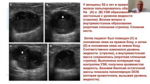 Мастопатия.  УЗИ диагностика кистозных образований молочных желез. Презентация. Часть 2.