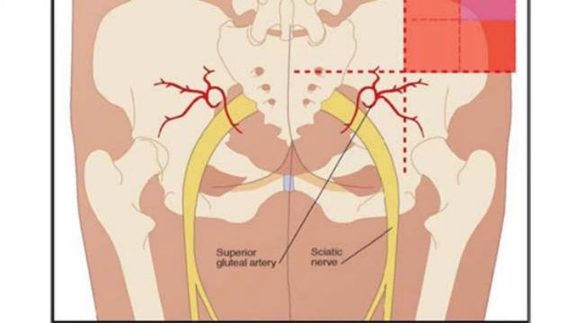 Testosterone: Intramuscular Gluteal Injection (Sustanon) смотреть онлайн