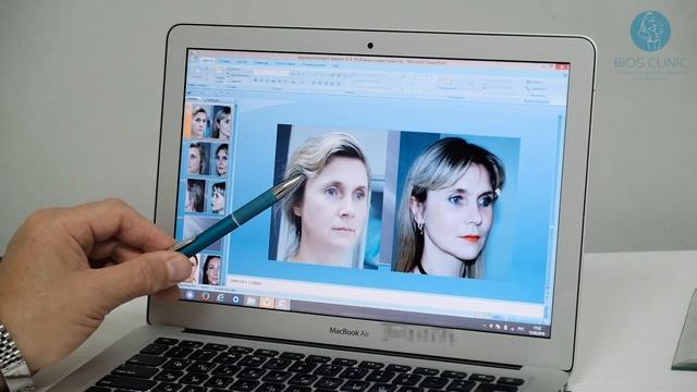 Ворошкевич А.А. об эндоскопической подтяжке лица. смотреть онлайн