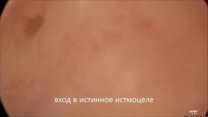 Гистероскопия. Несостоятельный рубец на матке после КС (редкий случай).