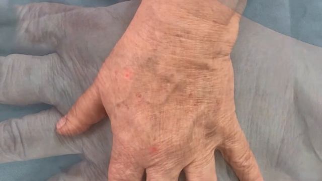 Пигментация На Кистях Рук- Результат Лазерного Удаления смотреть онлайн