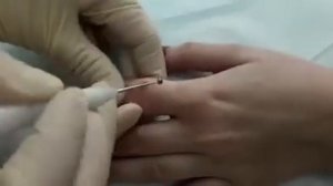 Удаление бородавки методом электрокоагуляции в Дельтаклиник