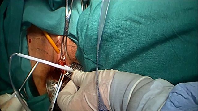 TVT-O Continence Surgery for Stress Urinary Incontinence смотреть онлайн