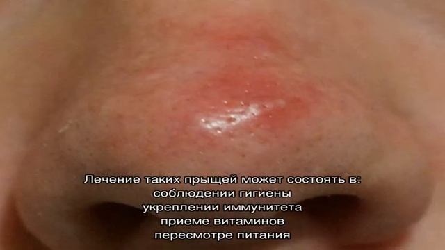 Прыщи на носу: причины у женщин и мужчин. Как избавиться от прыщей на носу за один день? смотреть онлайн