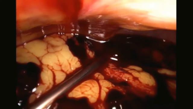 Ectopic pregnancy with massive haemoperitoneum by Dr. Samina Saleem смотреть онлайн