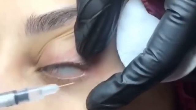 ПОДНИМАЕМ БРОВЬ ТОКСИНОМ и УГОЛОК ГЛАЗА смотреть онлайн