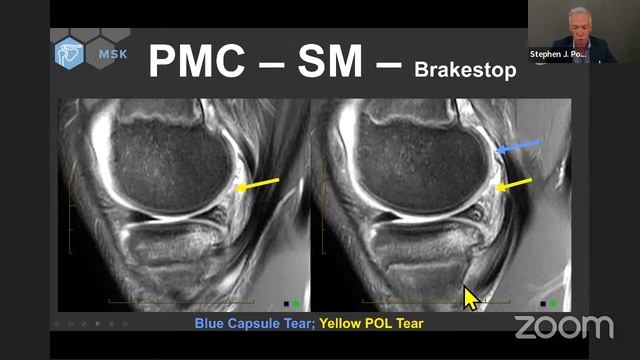 Noon Conference with Dr. Stephen J. Pomeranz - MRI of the Knee смотреть онлайн