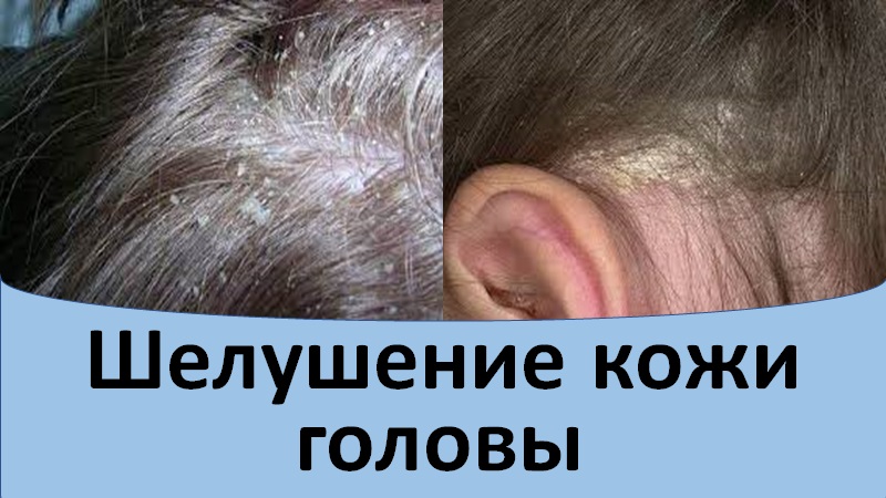 Шелушение кожи головы. смотреть онлайн