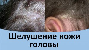 Шелушение кожи головы.