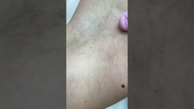 Электроэпиляция подмышечных впадин смотреть онлайн