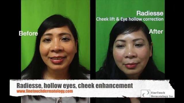Before and After Radiesse on Rolling Hills Estates Patient: Dr. Umar Non-Surgical Cheek Lift