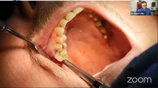 Sinus lift 101 смотреть онлайн