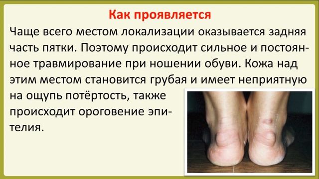 Что такое экзостоз пяточной кости? смотреть онлайн
