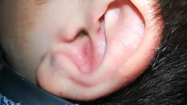прыщ в ухе смотреть онлайн