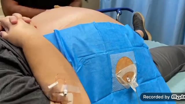 Цирроз печен. التليف الكبد.. cirrhosis of the liver смотреть онлайн