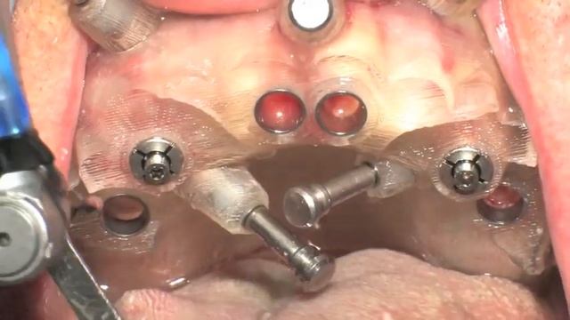 Immediate fixed Rehabilitation full arch with Toronto bridge,guided surgery,Nobel Biocare смотреть онлайн