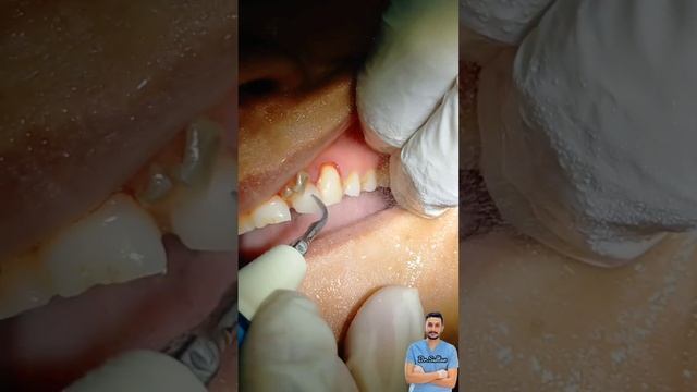 شاهد كيفية ازالة جير الأسنان ||Watch how to remove dental tartar#dentist_asmr#dr_abdullah_sultan_ смотреть онлайн