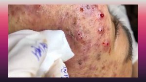 Выдавливание прыщей,много акне,воспаленные прыщи,акне,угри,залипалка,выдавил черные точки,подпишись