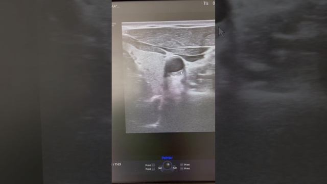 Атеросклероз. Бляшка в сонной артерии. Холестерин как снизить? Узи сосудов. Флеболог смотреть онлайн