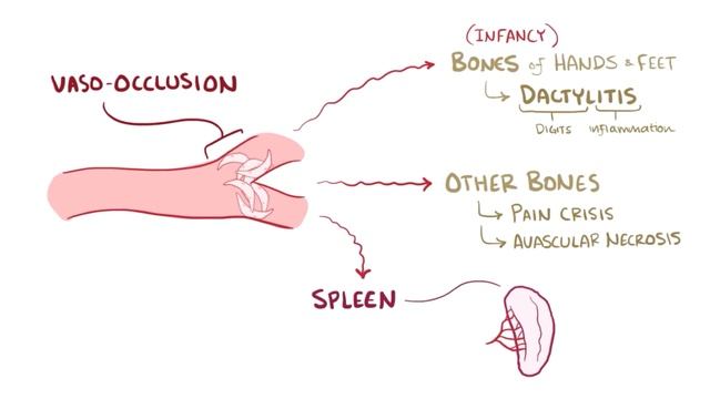 Sickle cell anemia - causes, symptoms, diagnosis, treatment & pathology смотреть онлайн