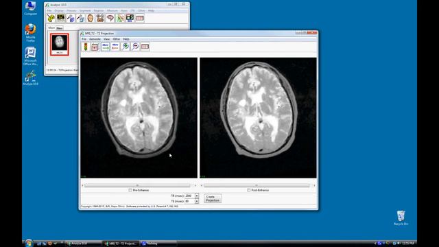 The MRI T2 Optimization Add-On - Enhancing T2 Weighted MR Images смотреть онлайн