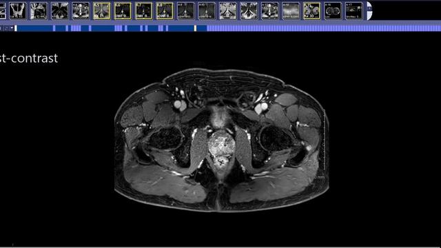 How to read a Prostate MRI смотреть онлайн