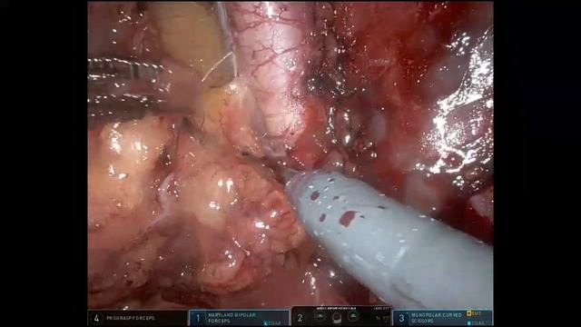 Robotic Right extended pelvic lymph node dissection смотреть онлайн