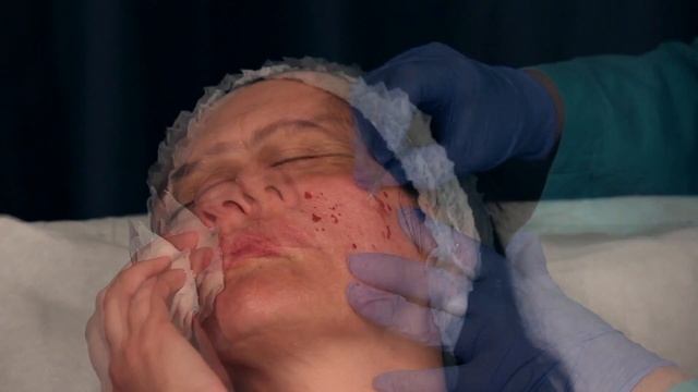 Mikronakłuwanie + PRX T33 W Medycynie Estetycznej