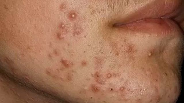Юношеские угри