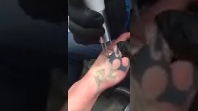 Лазерное удаление татуировки Сtrl+z смотреть онлайн