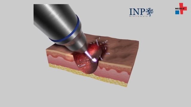 Physical plasma – the future of skin therapy? смотреть онлайн