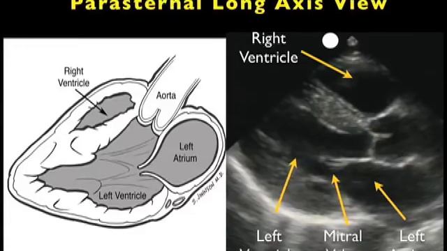 Cardiac Ultrasound - Parasternal Long Axis - Part 1 - Sonosite, Inc. смотреть онлайн