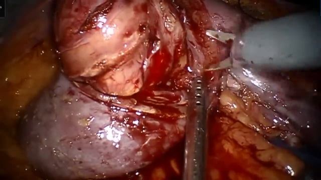 Robotic partial nephrectomy Роботическая резекция почки смотреть онлайн