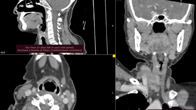 CT Neck Anatomy (Radiology Basics)| Anuj Aggarwal смотреть онлайн