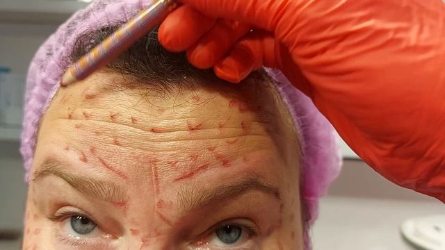 Токсин  разметка/до-после.(1)