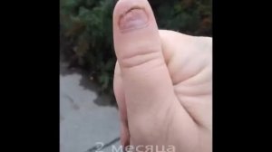 рост ногтя после удаления