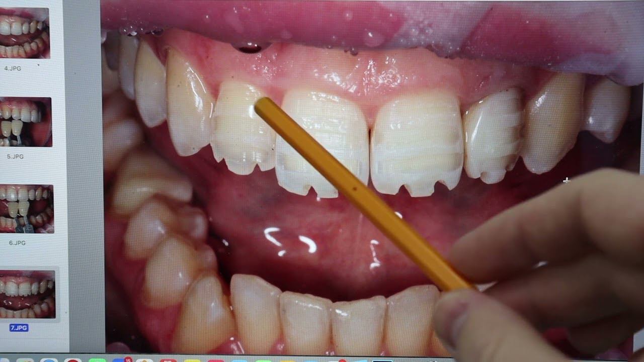 Стомбудни#11 ЗАЛЕПИЛ ДЫРКУ?